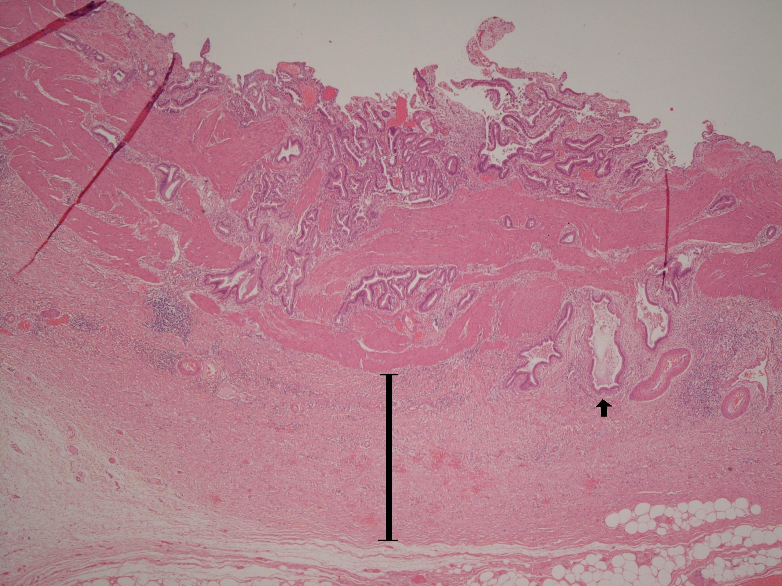 Chronic cholecystitis